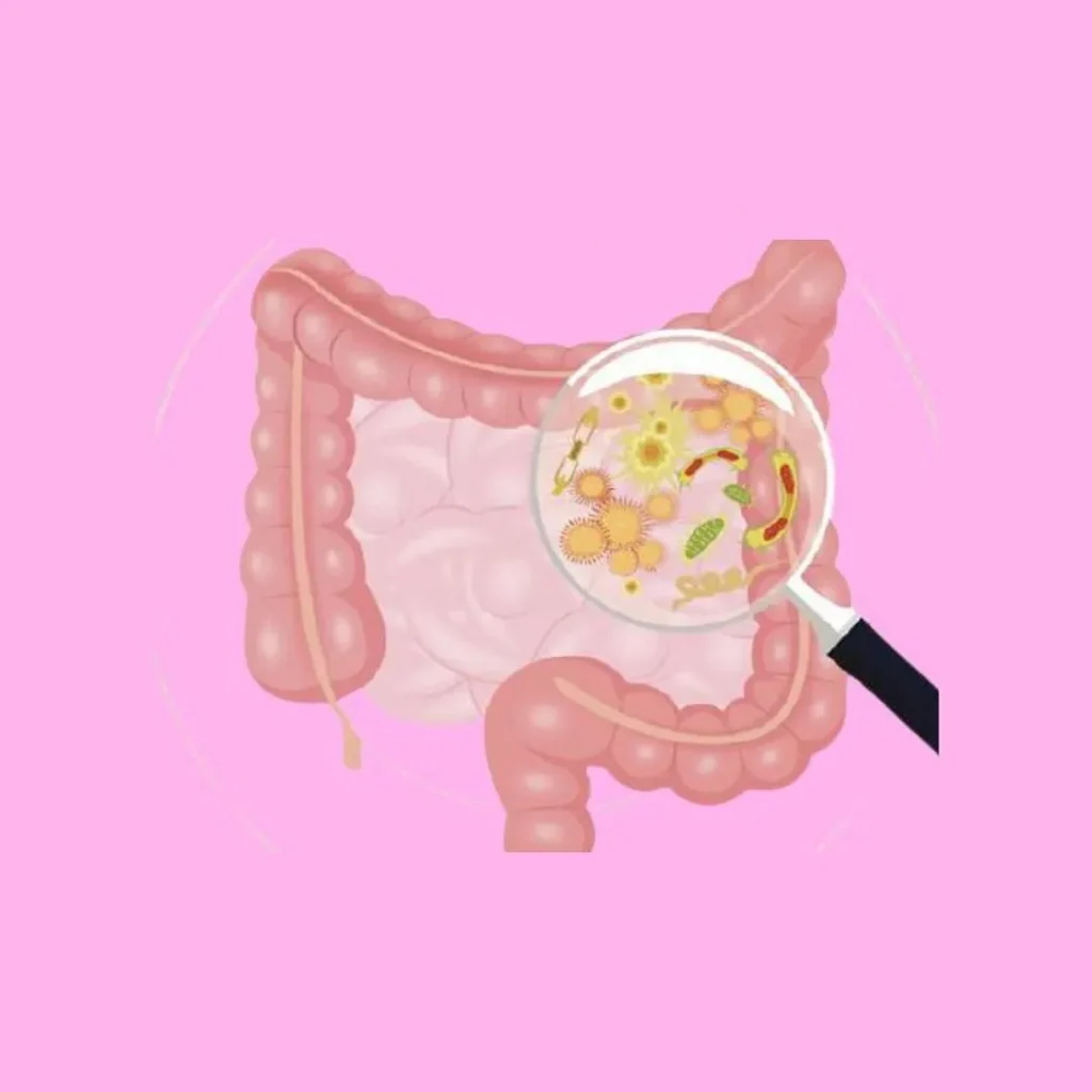 Sindrome dell’intestino irritabile